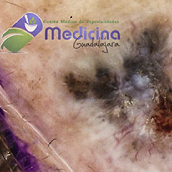 Dermatologo Especialista en dermatoscopia para el diagnóstico de cáncer de piel sin biopsia en Guadalajara Jalisco