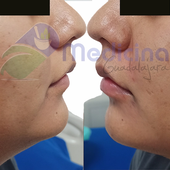 Relleno de labios, Aumento de labios Guadalajara Jalisco Mexico, Aplicación de ácido hialurónico en guadalajara