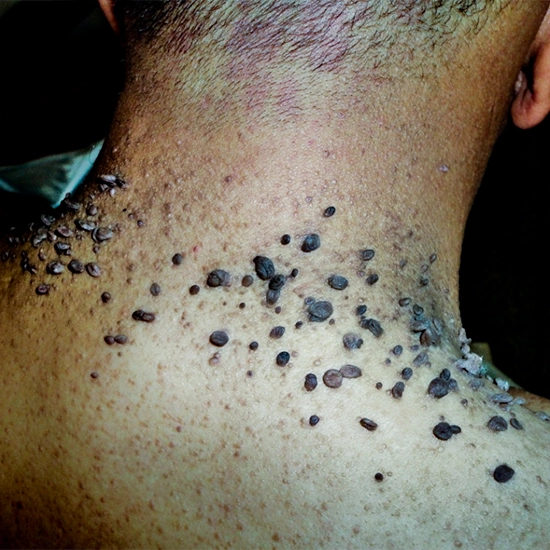 retiro de verrugas en Guadalajara Jalisco Mexico, quitar verrugas en Guadalajara Jalisco Mexico