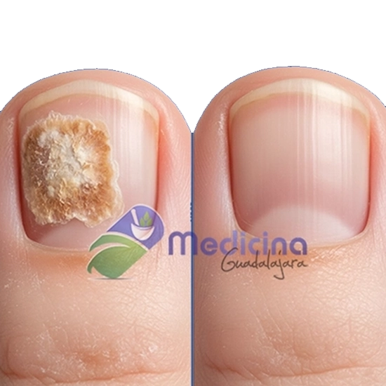 Dermatologo Especialista en tratamiento de honogos de las uñas en Guadalajara Jalisco Mexico